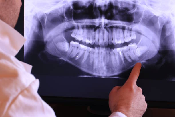 Best Emergency Tooth Extraction in Lexington, VA