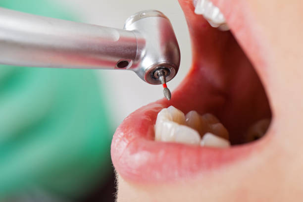 Best Emergency Dental Care for Broken or Chipped Teeth in Lexington, VA